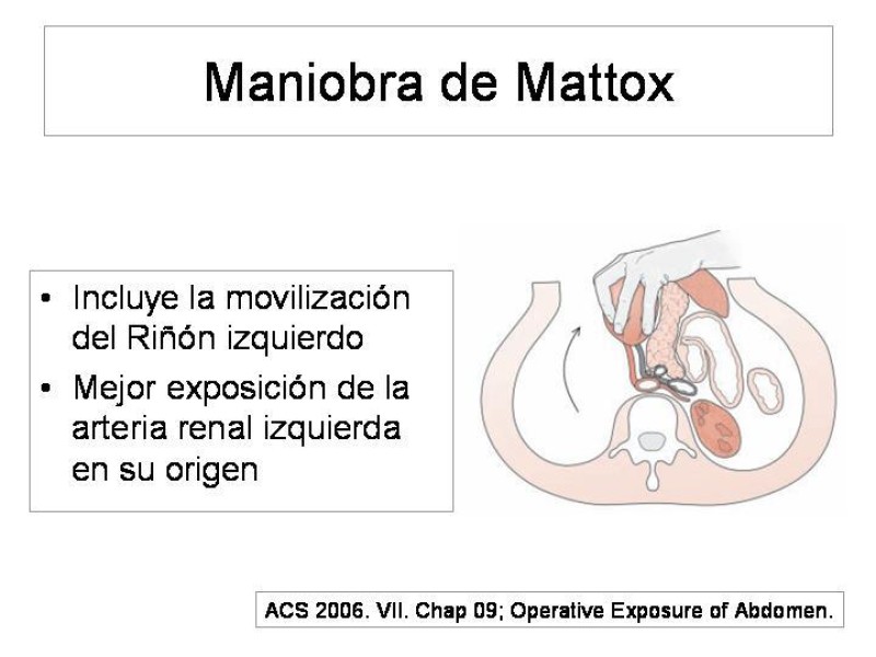 Diapositiva 18 de Maniobras Quirúrgicas de Exposición Abdominal