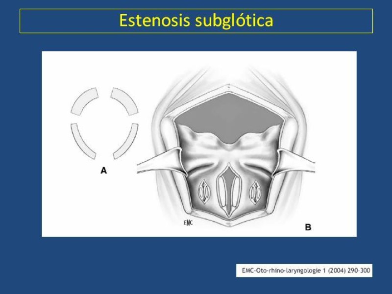 Diapositiva 25 de Estenosis laringo-traqueal pt. II