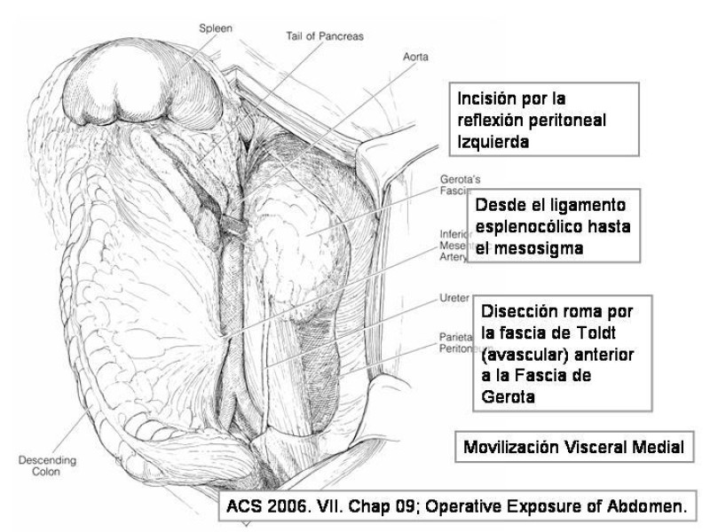 Diapositiva 17 de Maniobras Quirúrgicas de Exposición Abdominal
