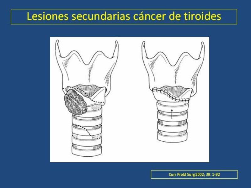 Diapositiva 34 de Estenosis laringo-traqueal pt. II