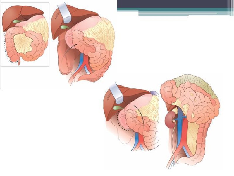 Diapositiva 14 de Hematoma Retroperitoneal