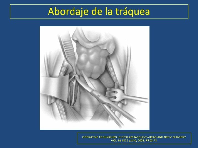 Diapositiva 2 de Estenosis laringo-traqueal pt. II