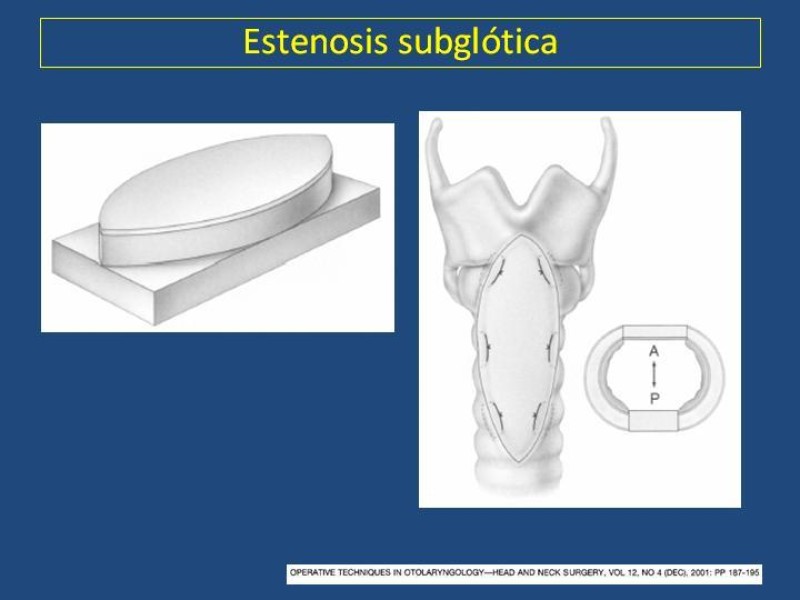 Diapositiva 16 de Estenosis laringo-traqueal pt. II