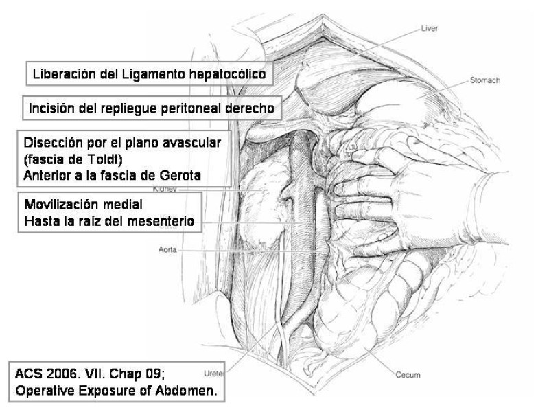 Diapositiva 21 de Maniobras Quirúrgicas de Exposición Abdominal