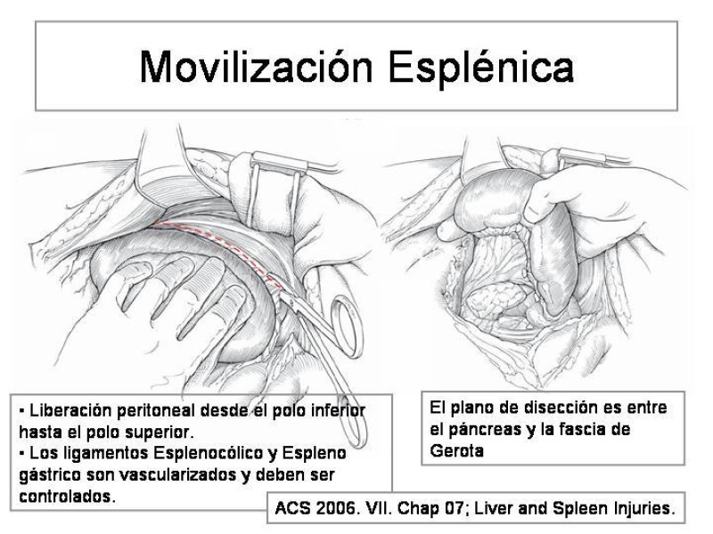 Diapositiva 13 de Maniobras Quirúrgicas de Exposición Abdominal