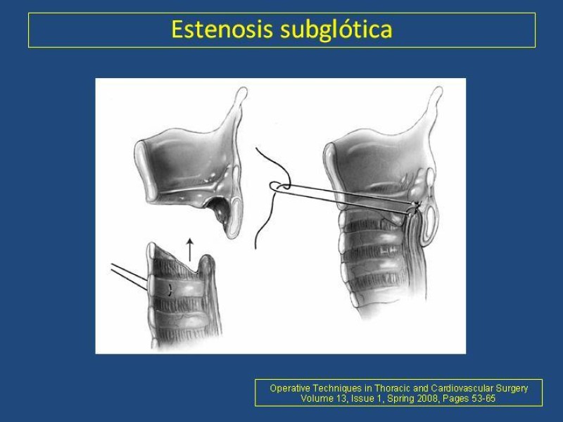 Diapositiva 12 de Estenosis laringo-traqueal pt. II