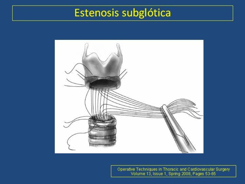 Diapositiva 9 de Estenosis laringo-traqueal pt. II