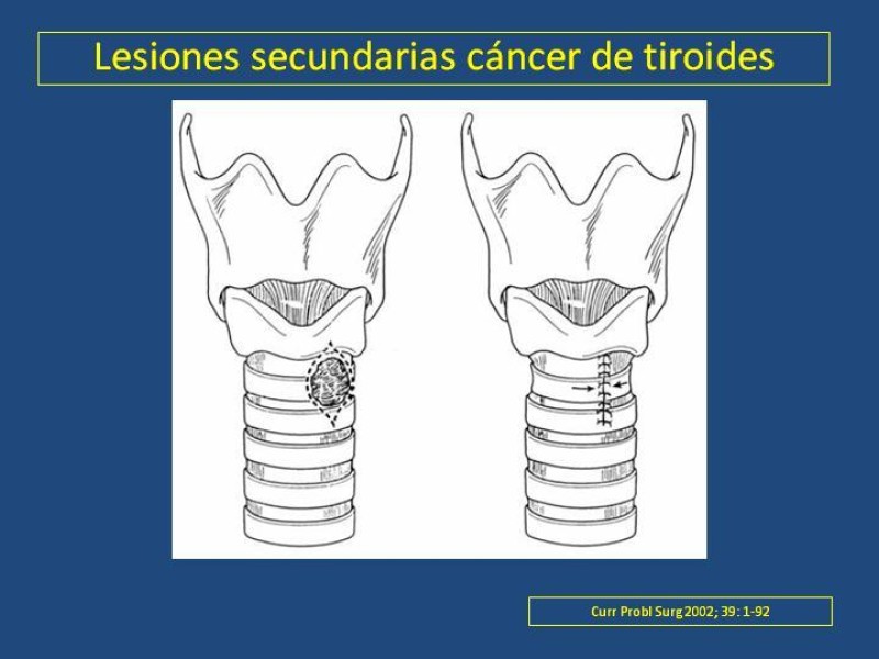 Diapositiva 29 de Estenosis laringo-traqueal pt. II