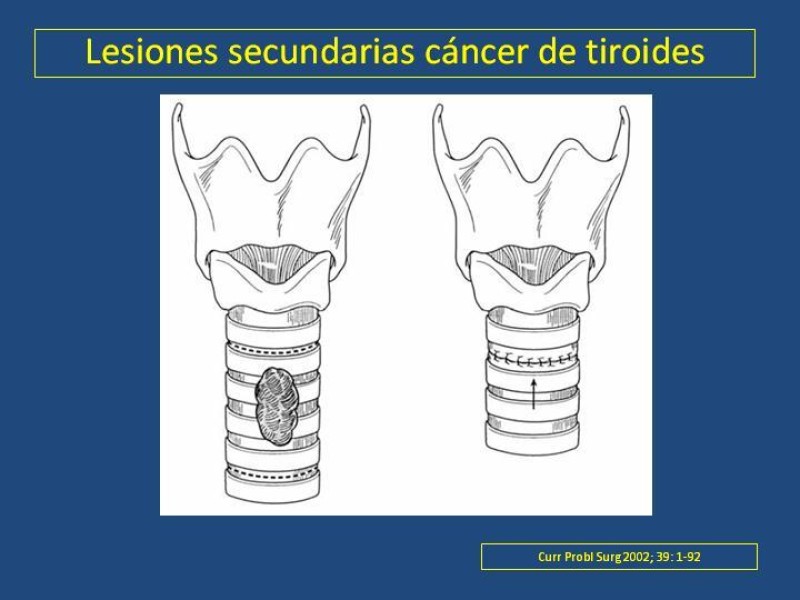 Diapositiva 33 de Estenosis laringo-traqueal pt. II