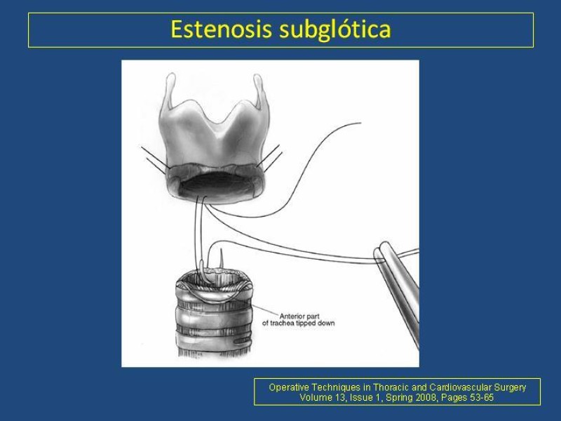 Diapositiva 7 de Estenosis laringo-traqueal pt. II