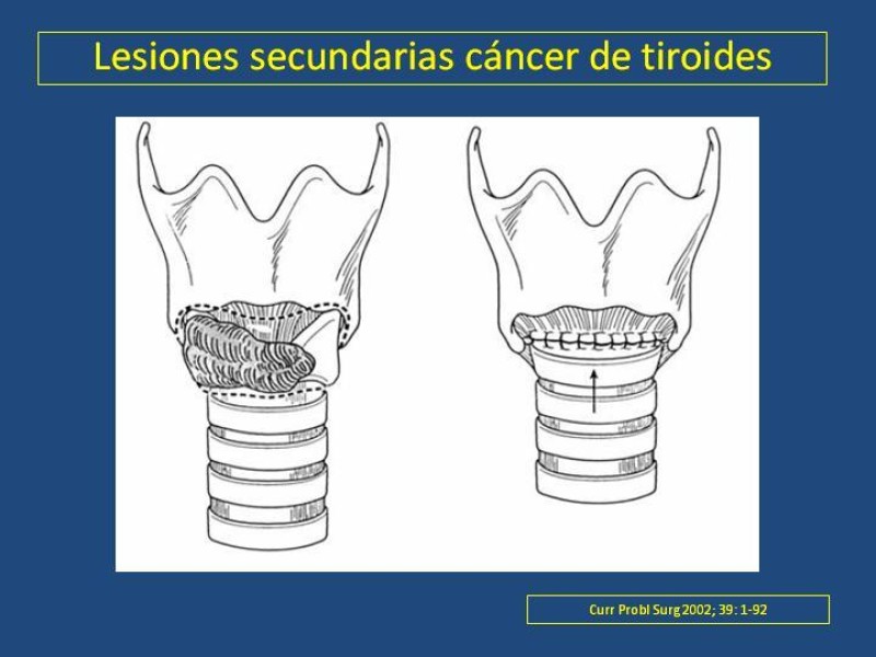 Diapositiva 31 de Estenosis laringo-traqueal pt. II