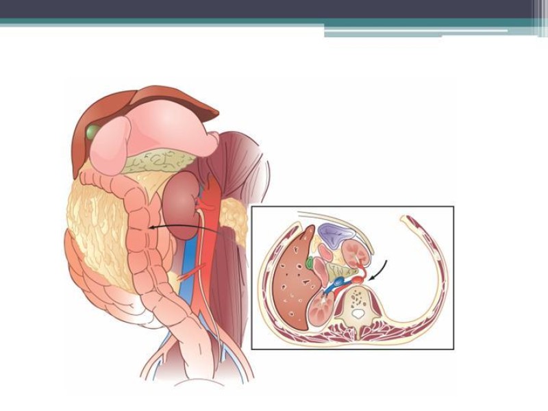 Diapositiva 12 de Hematoma Retroperitoneal