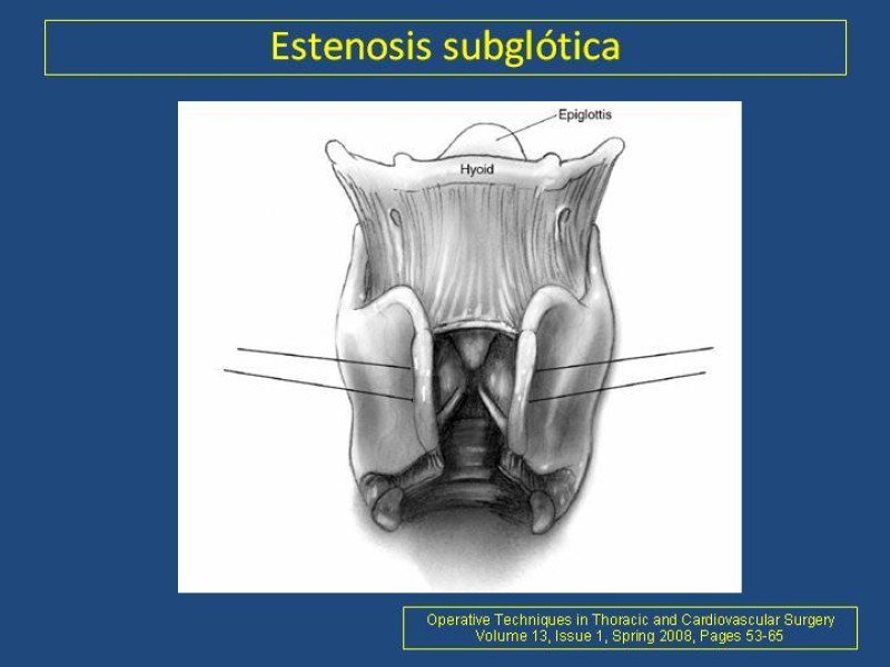 Diapositiva 14 de Estenosis laringo-traqueal pt. II