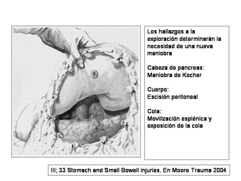Diapositiva 10 de Maniobras Quirúrgicas de Exposición Abdominal