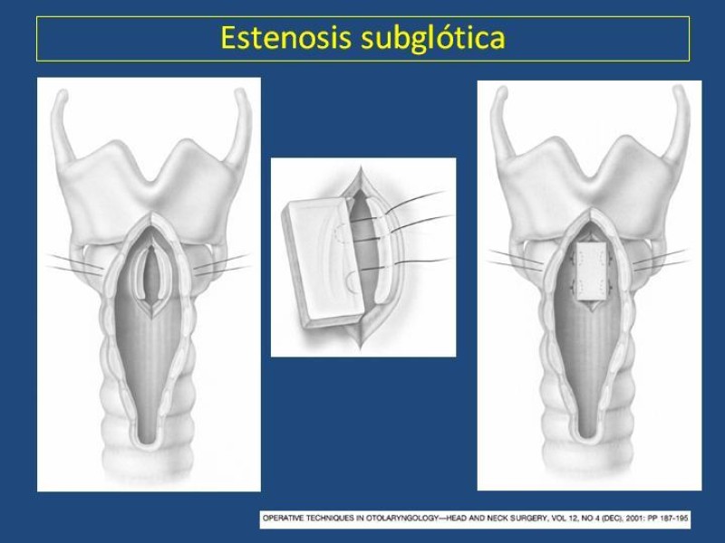 Diapositiva 17 de Estenosis laringo-traqueal pt. II