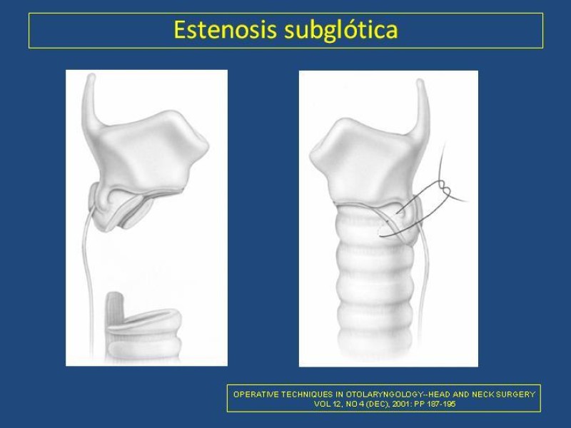 Diapositiva 20 de Estenosis laringo-traqueal pt. II