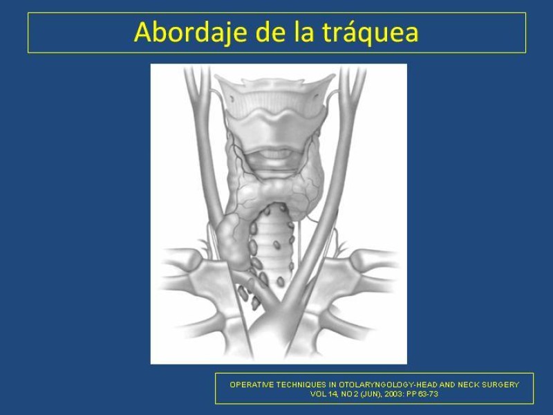 Diapositiva 4 de Estenosis laringo-traqueal pt. II