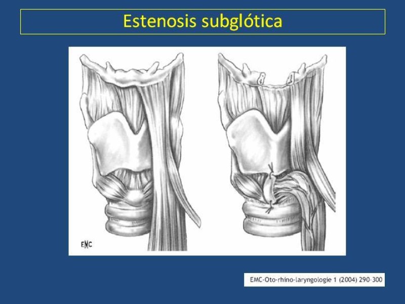 Diapositiva 24 de Estenosis laringo-traqueal pt. II
