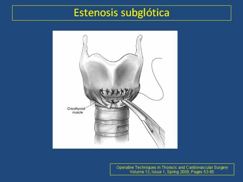 Diapositiva 11 de Estenosis laringo-traqueal pt. II