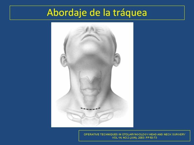 Diapositiva 39 de Estenosis laringo-traqueal pt. I