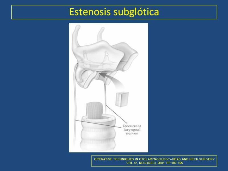 Diapositiva 22 de Estenosis laringo-traqueal pt. II