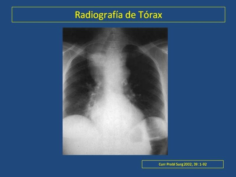 Diapositiva 16 de Estenosis laringo-traqueal pt. I