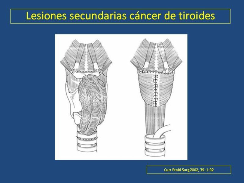 Diapositiva 35 de Estenosis laringo-traqueal pt. II