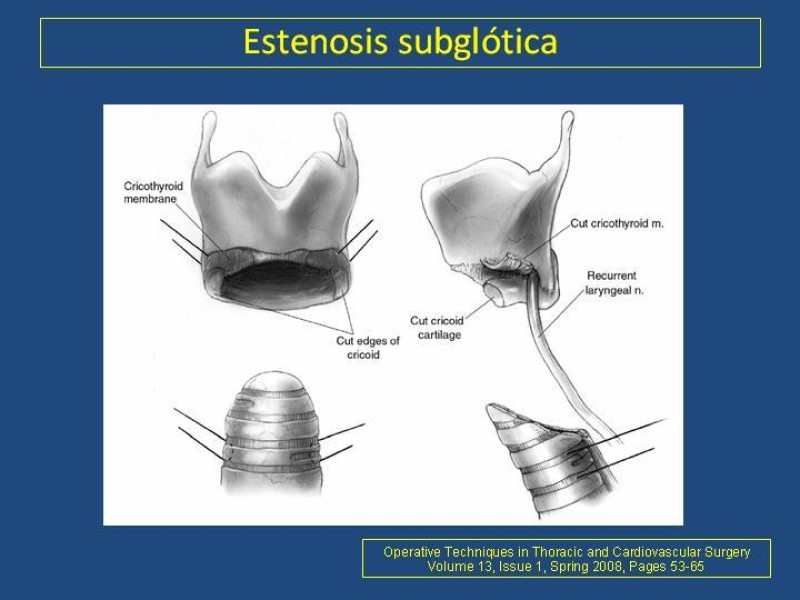 Diapositiva 6 de Estenosis laringo-traqueal pt. II