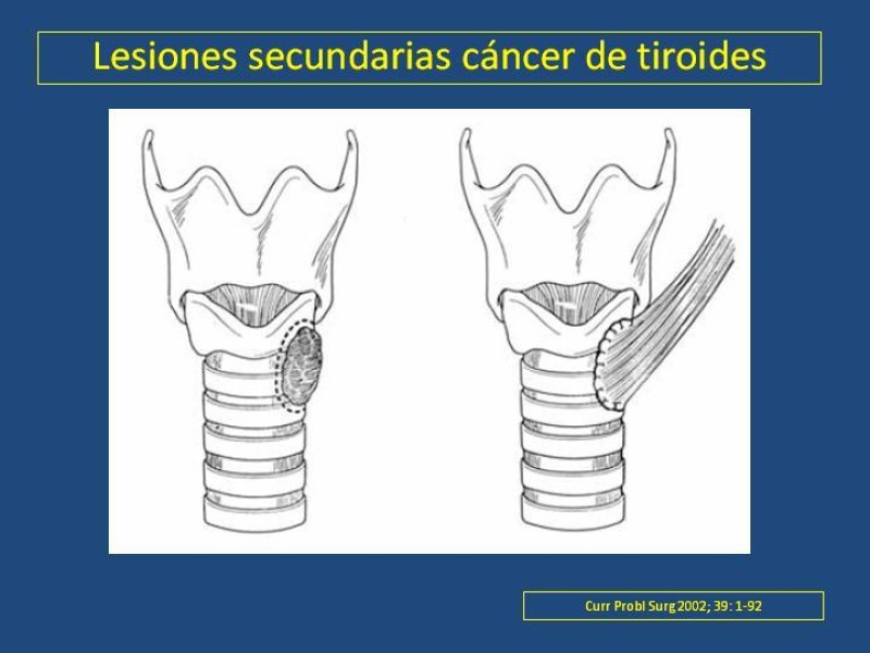 Diapositiva 28 de Estenosis laringo-traqueal pt. II