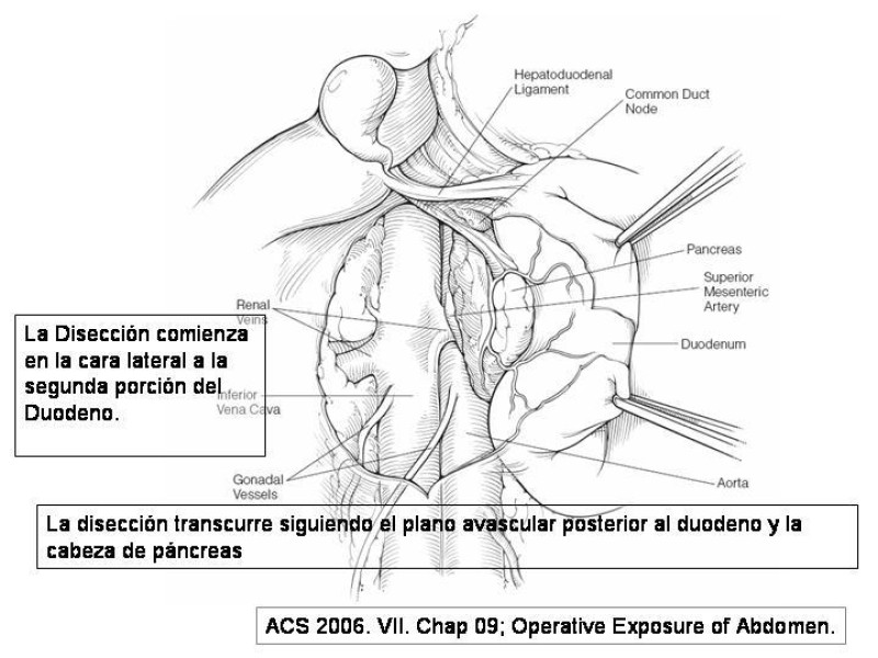 Diapositiva 12 de Maniobras Quirúrgicas de Exposición Abdominal