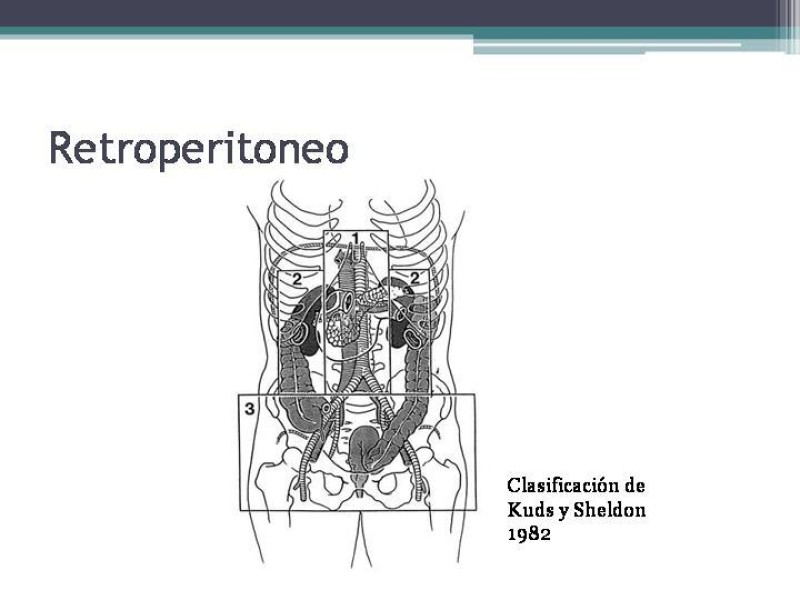Diapositiva 1 de Hematoma Retroperitoneal