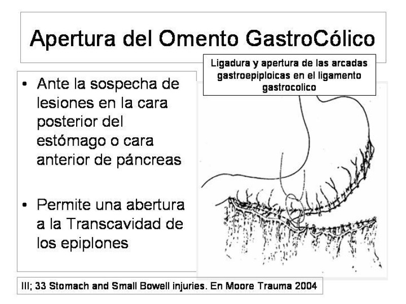 Diapositiva 9 de Maniobras Quirúrgicas de Exposición Abdominal