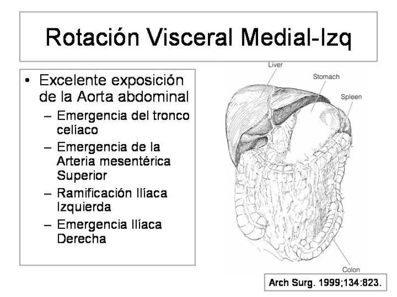 Diapositiva 16 de Maniobras Quirúrgicas de Exposición Abdominal