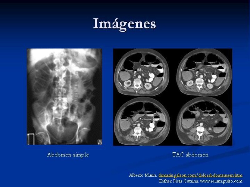 Diapositiva 10 de Ileo postoperatorio