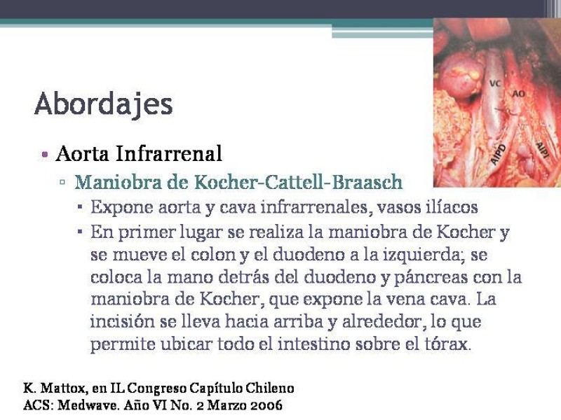 Diapositiva 13 de Hematoma Retroperitoneal