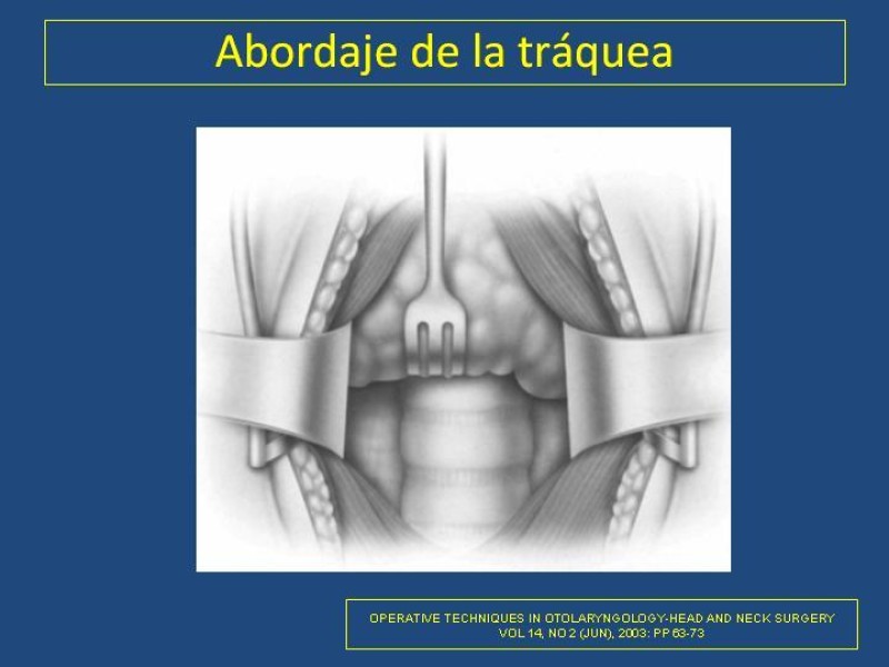 Diapositiva 1 de Estenosis laringo-traqueal pt. II