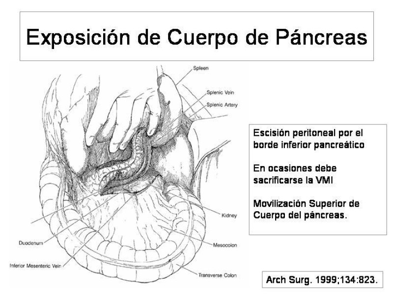 Diapositiva 14 de Maniobras Quirúrgicas de Exposición Abdominal