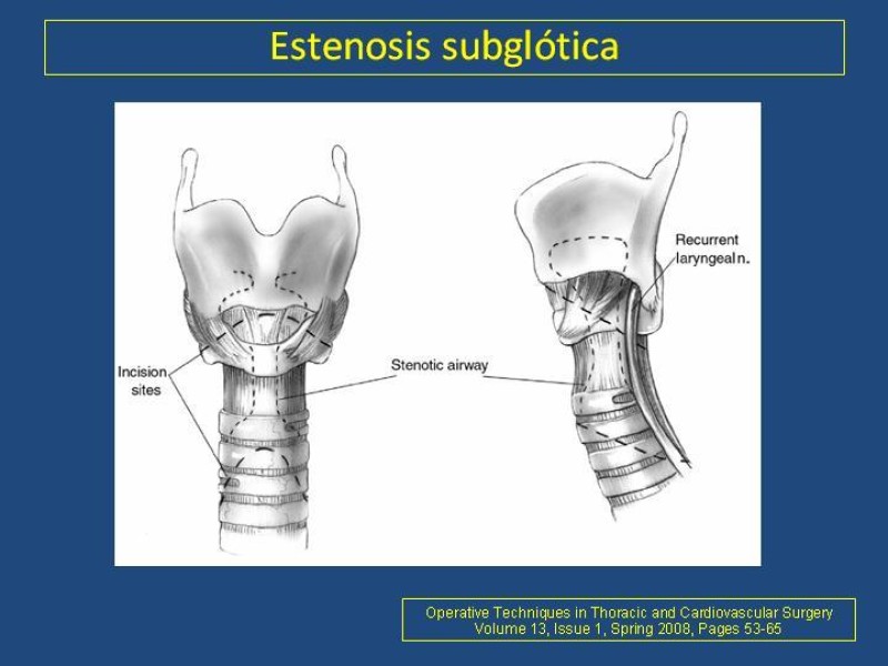 Diapositiva 5 de Estenosis laringo-traqueal pt. II