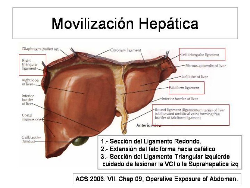 Diapositiva 22 de Maniobras Quirúrgicas de Exposición Abdominal