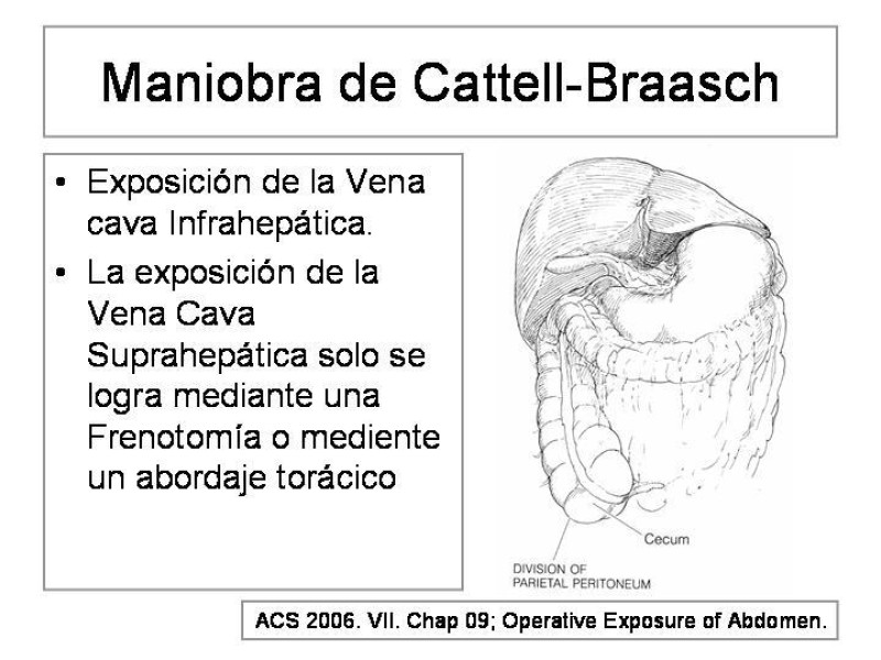 Diapositiva 20 de Maniobras Quirúrgicas de Exposición Abdominal