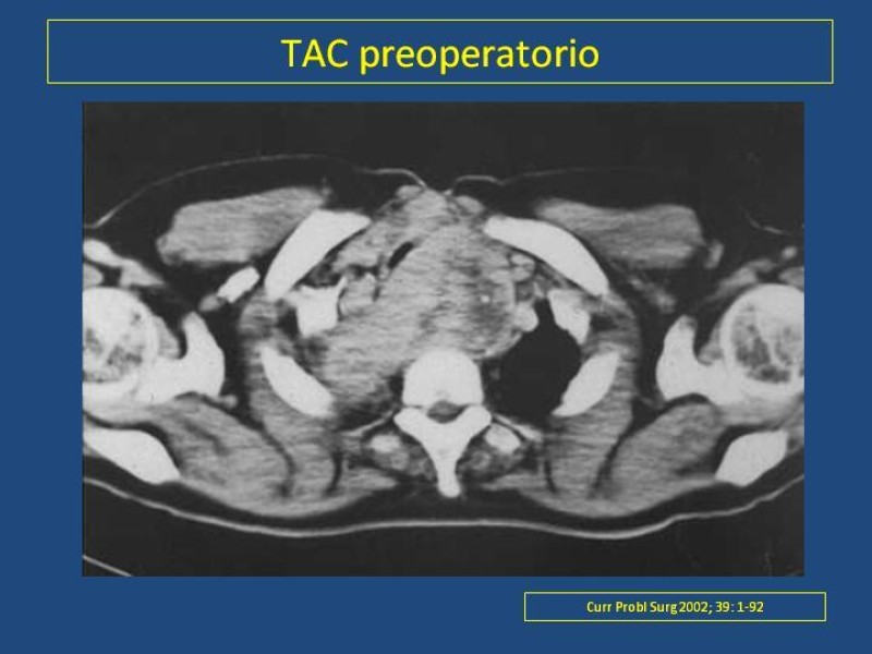 Diapositiva 17 de Estenosis laringo-traqueal pt. I
