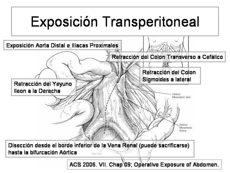 Diapositiva 19 de Maniobras Quirúrgicas de Exposición Abdominal