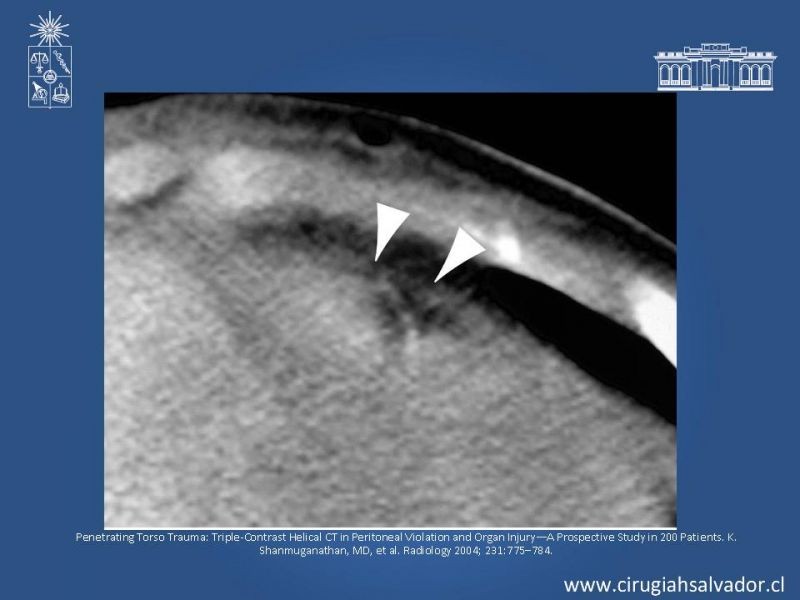 Diapositiva 20 de Imágenes en Trauma Abdominal 