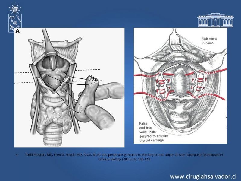 Diapositiva 17 de Manejo del trauma laríngeo