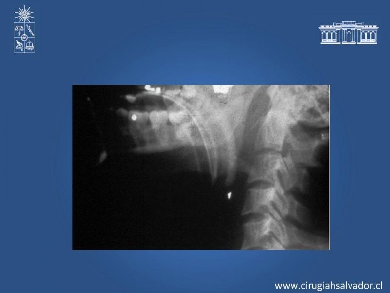 Diapositiva 17 de Manejo del trauma cervical penetrante