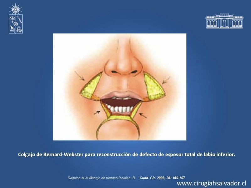 Diapositiva 46 de Trauma Facial: Manejo Quirúrgico de Partes Blandas  