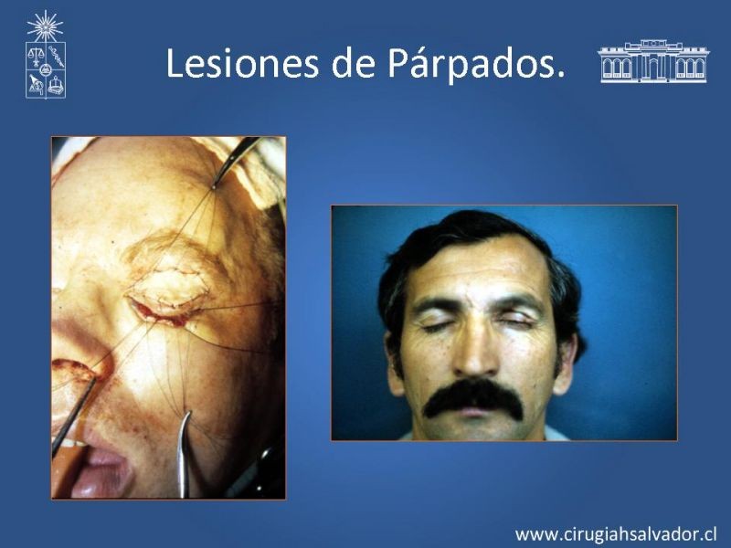 Diapositiva 34 de Trauma Facial: Manejo Quirúrgico de Partes Blandas  
