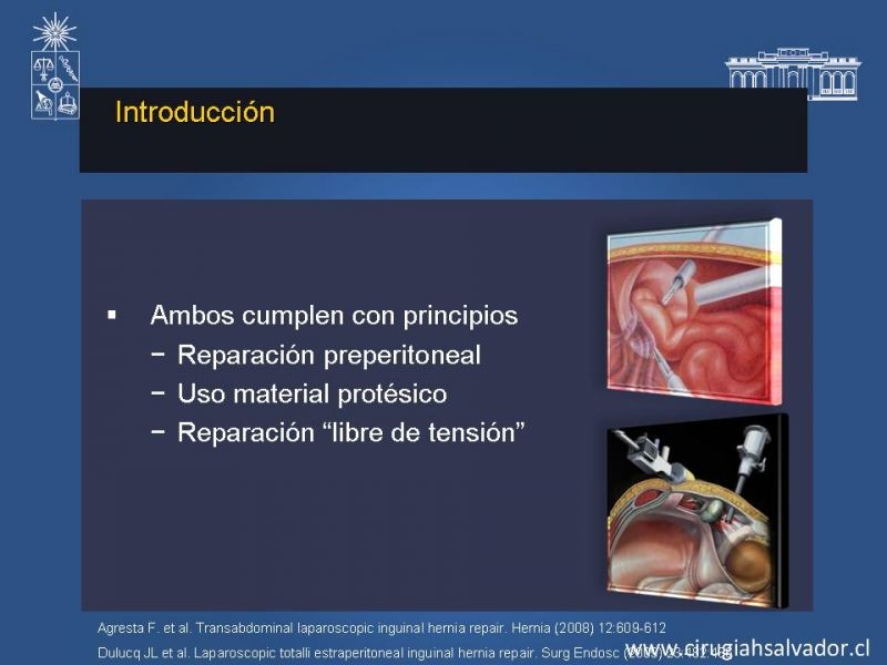 Diapositiva 6 de Hernioplastia Inguinal Laparoscópica