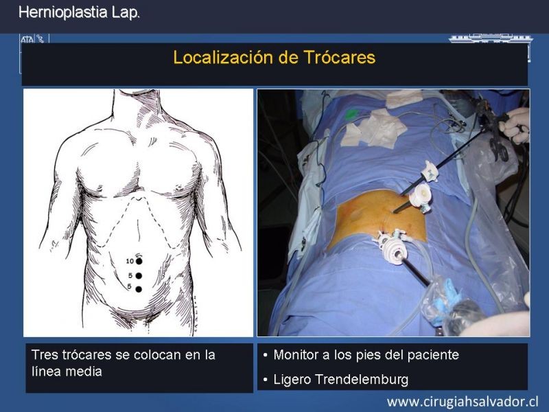 Diapositiva 10 de Hernioplastia Inguinal Laparoscópica