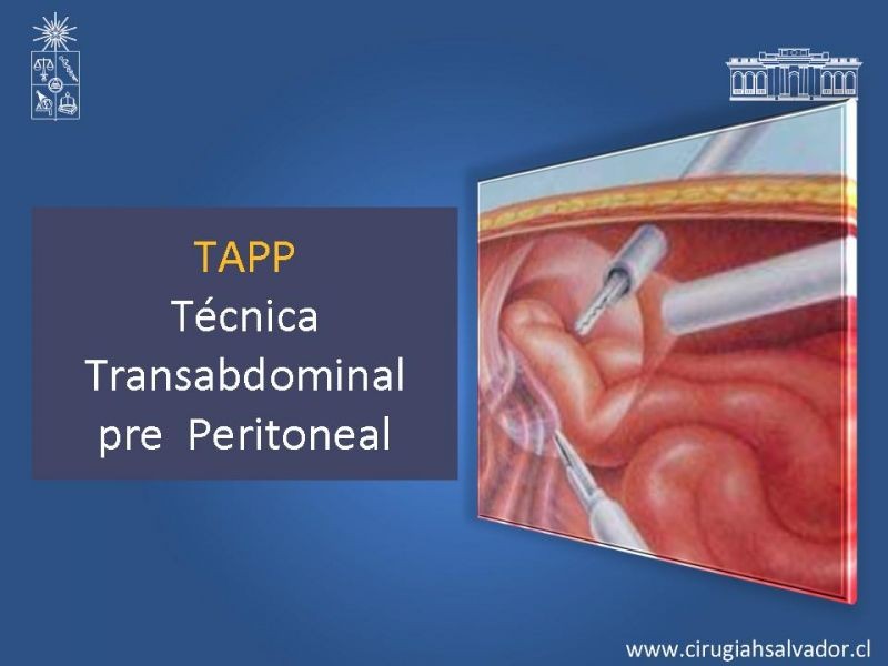 Diapositiva 16 de Hernioplastia Inguinal Laparoscópica